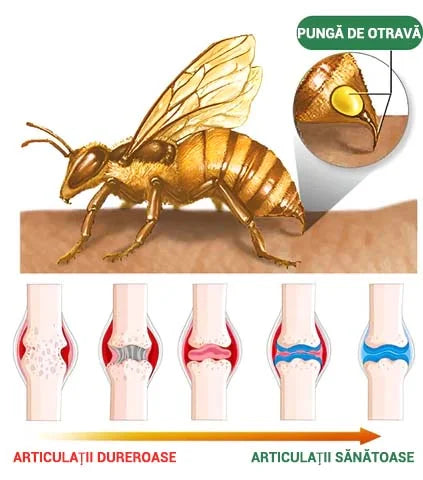 🌿🐝🌿BEARNICA™ Cremă Avansată pentru Îngrijirea Articulațiilor și Osoasă cu Venin de Albină🔥 (Ultima zi de promoție, 20% reducere)